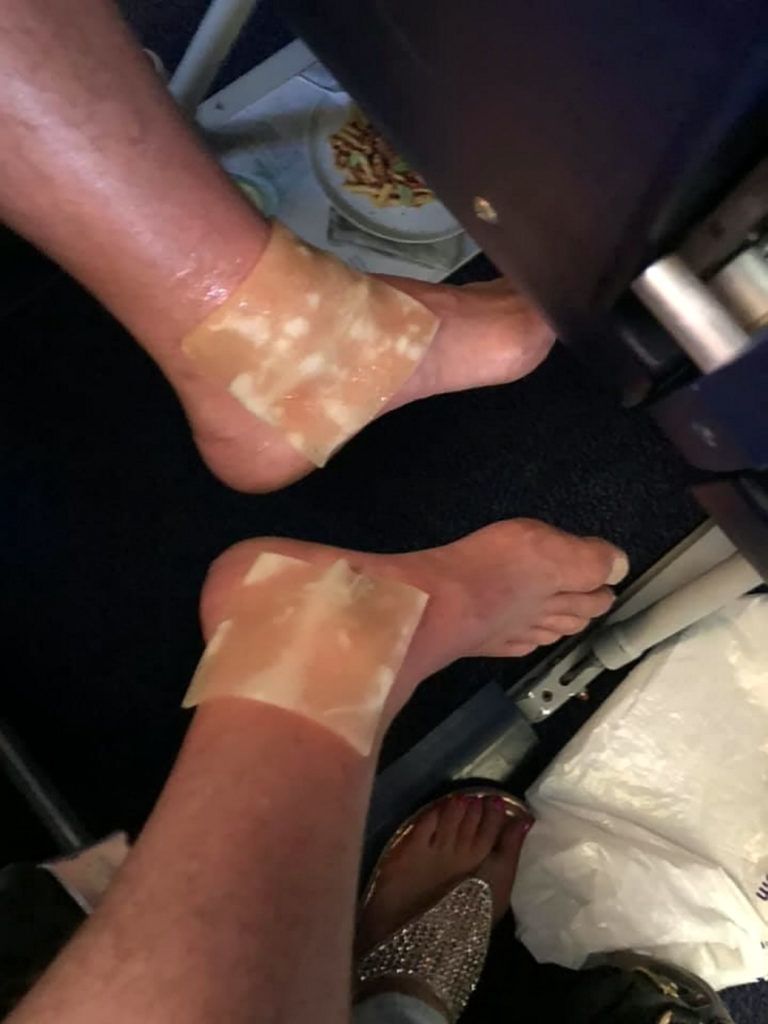Gel packs on Thomas McNab's ankles. Thomas McNab, 49, was left with horrific burns after Ryanair cabin crew accidentally spily boiling water on his ankles - and then allegedly failed to administer proper first aid. See SWNS story SWSCburns. A budget airline has been blasted for its treatment of a man who was left with horrific burns after boiling water was poured over him by a member of staff. Thomas McNab, 49, was flying home from Fara, Portugal, when he was accidentally scalded by a member of the Ryanair cabin crew. But his horrified partner, Tonina Ciantar, claims staff failed to administer appropriate first aid and left him blistering as she watched on helplessly. Thomas was left "screaming" when staffed spilt boiling water on him, causing horrendous burns and blistering to his ankles. ***EXCLUSIVE***